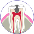 大きいむし歯の治療